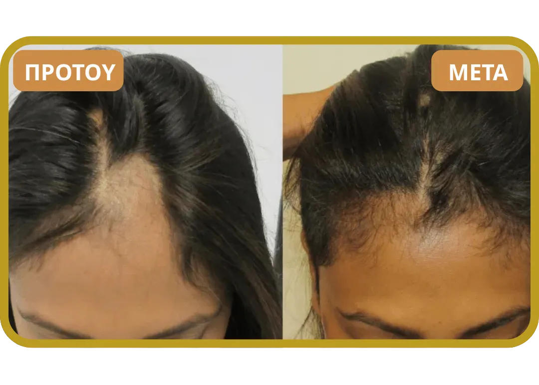 Orylo™ RootBoost Σαμπουάν Αναζωογόνησης Μαλλιών v2 (Women)