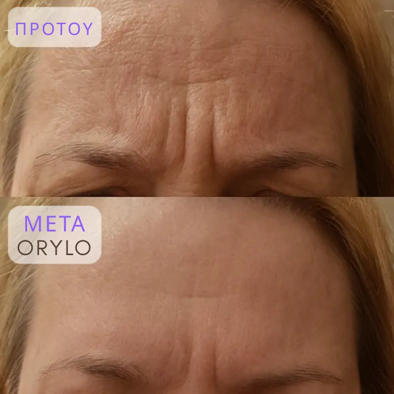 Collagen Scar Tape