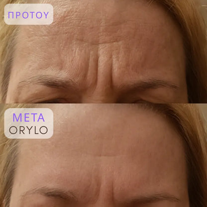 Collagen Scar Tape