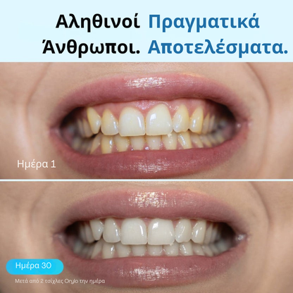 Τσίχλα Λεύκανσης Δοντιών