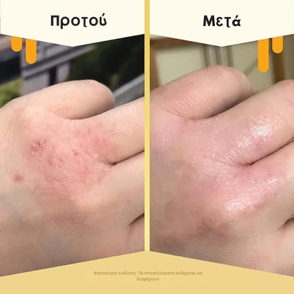Honey Eczema Cream for Kids